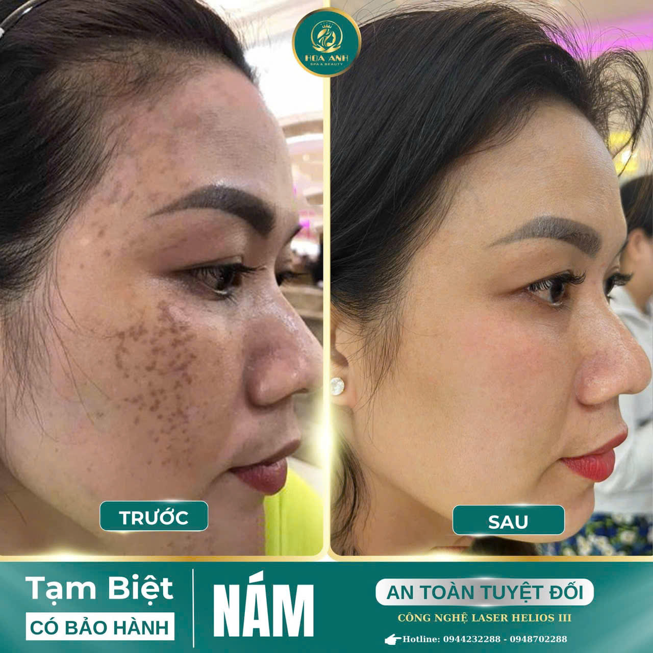 điều trị nám