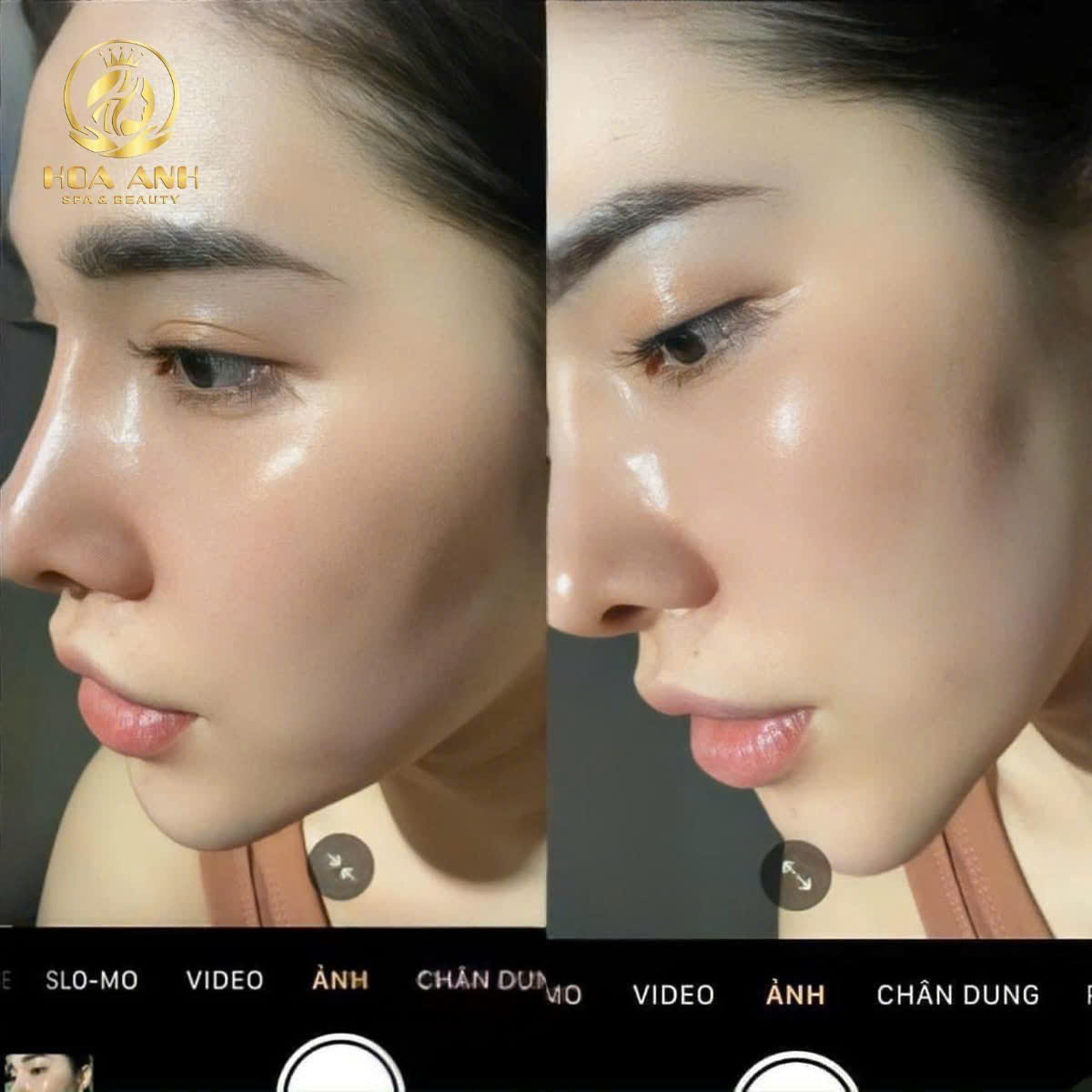 tiêm meso căng bóng