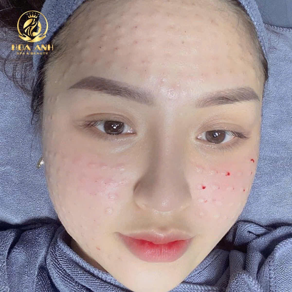 tiêm meso căng bóng