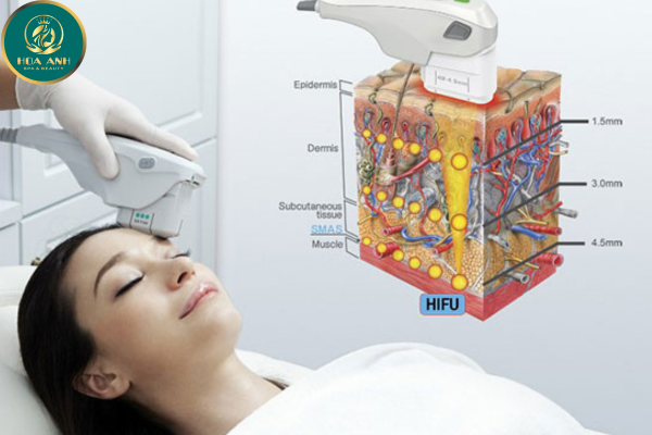 nâng cơ hifu trẻ hóa