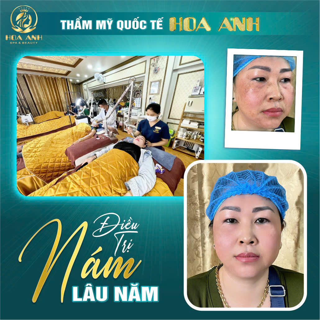 điều trị nám