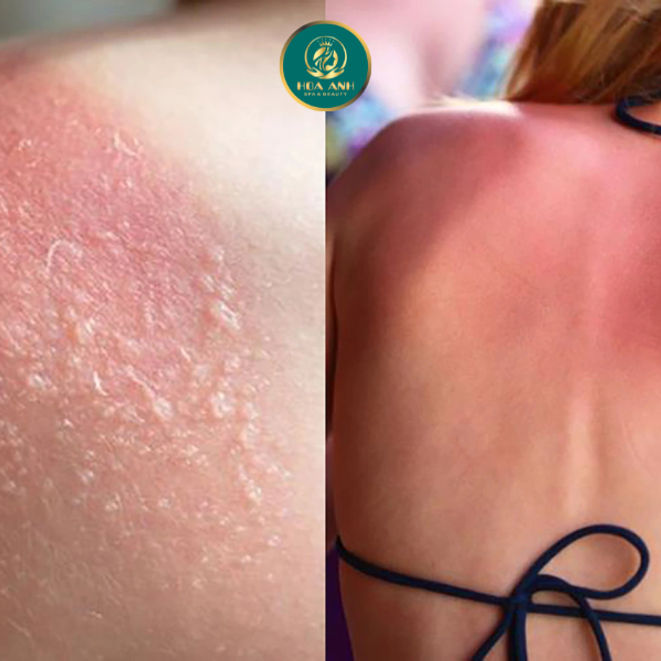 phục hồi da sau cháy nắng