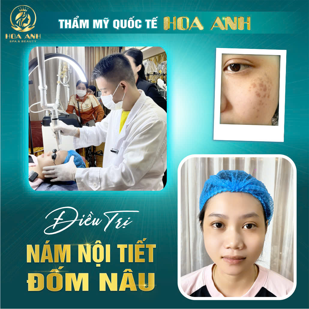 điều trị nám