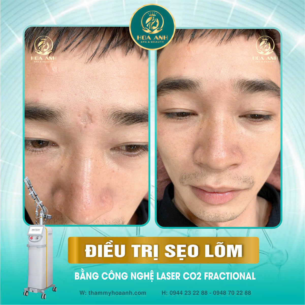 điều trị sẹo