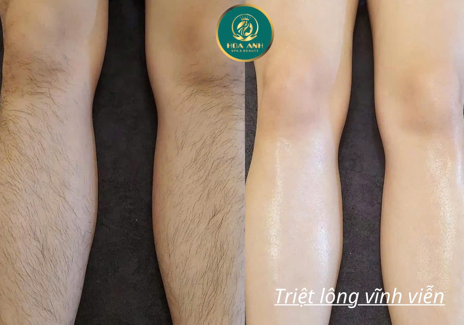 triệt lông vĩnh viễn