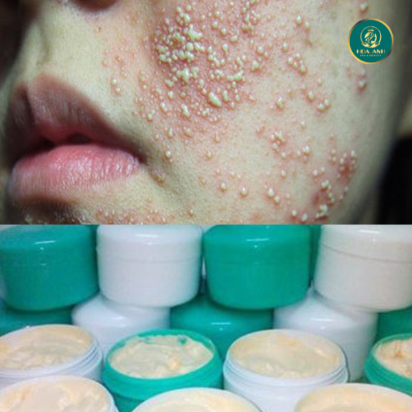 ngưng dùng sản phẩm chứa coticoid