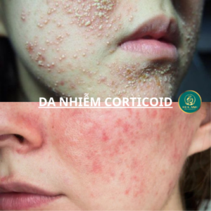 Da nhiễm corticoid