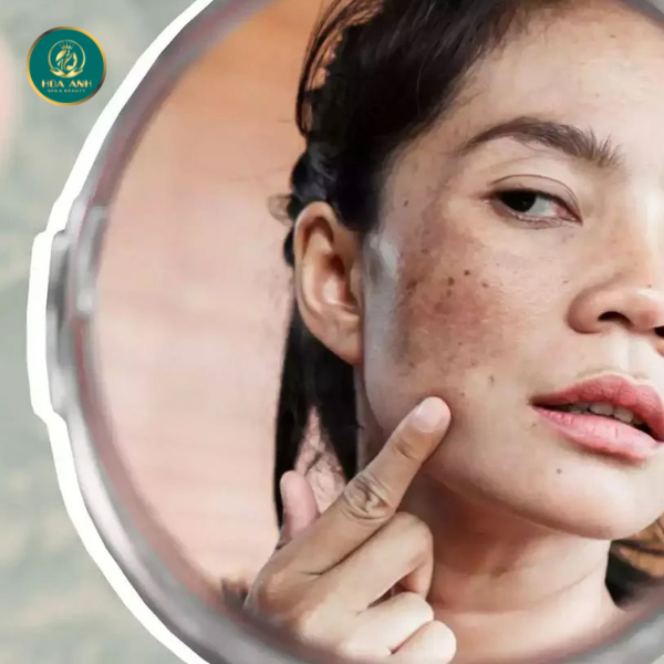 da bị nám do tiếp xúc nắng