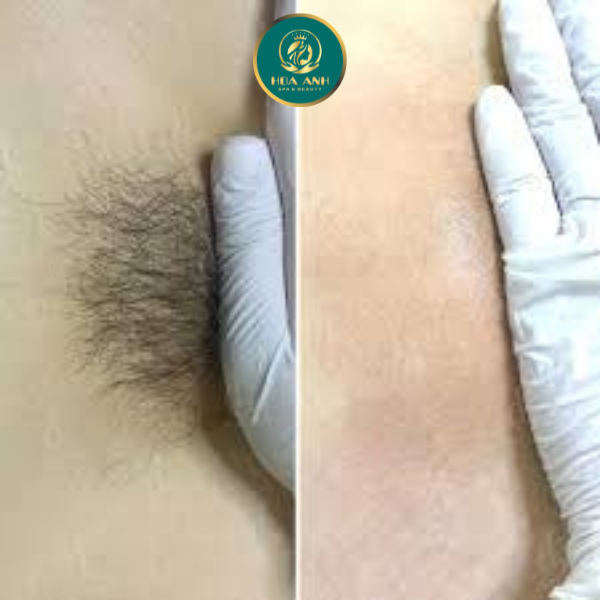 Triệt lông bikini