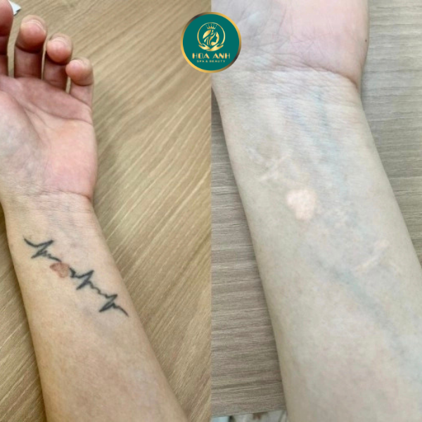 laser xóa hình xăm 