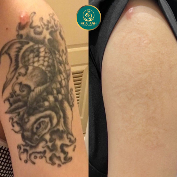 laser xóa hình xăm 
