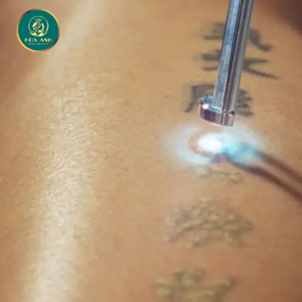 laser xóa hình xăm