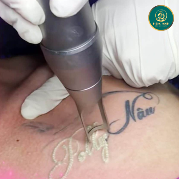 laser xóa hình xăm 