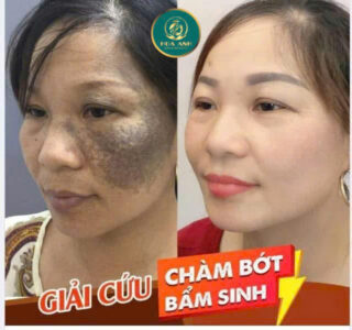 xóa bớt trên da