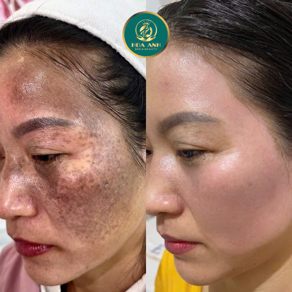 Điều trị xóa bớt