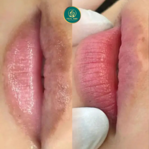 môi thâm trước và sau xử lý