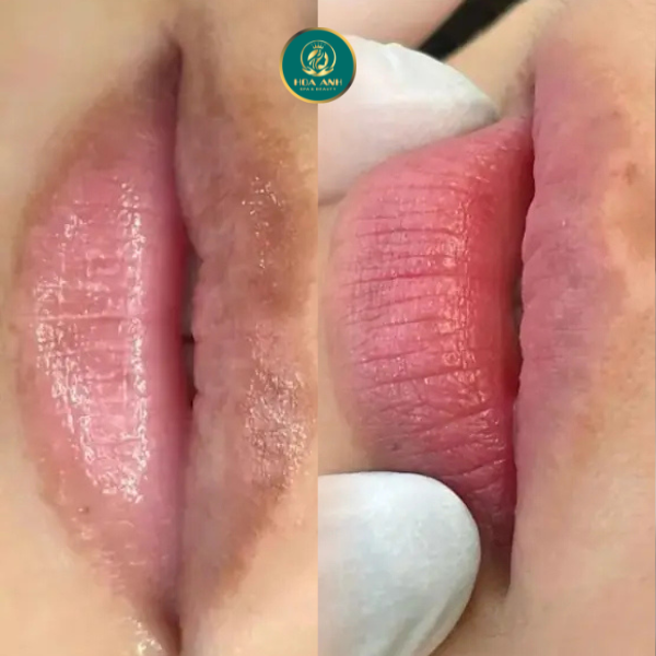 môi thâm trước và sau xử lý