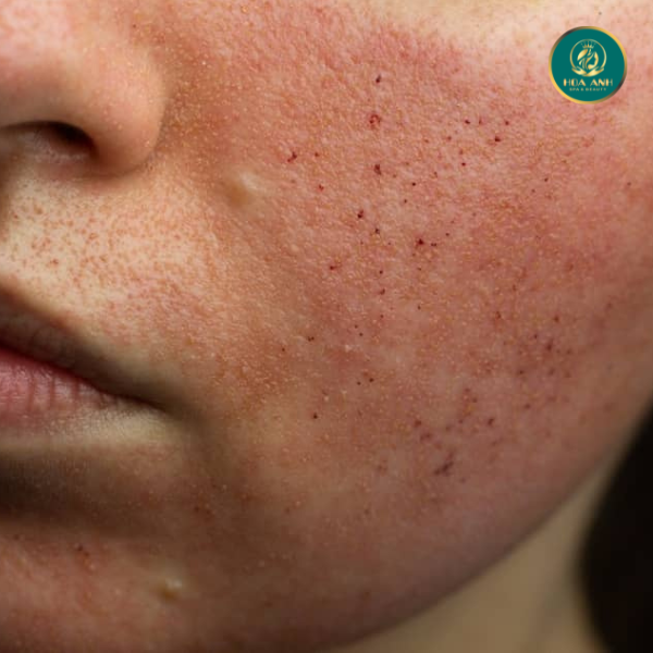 laser điều trị da