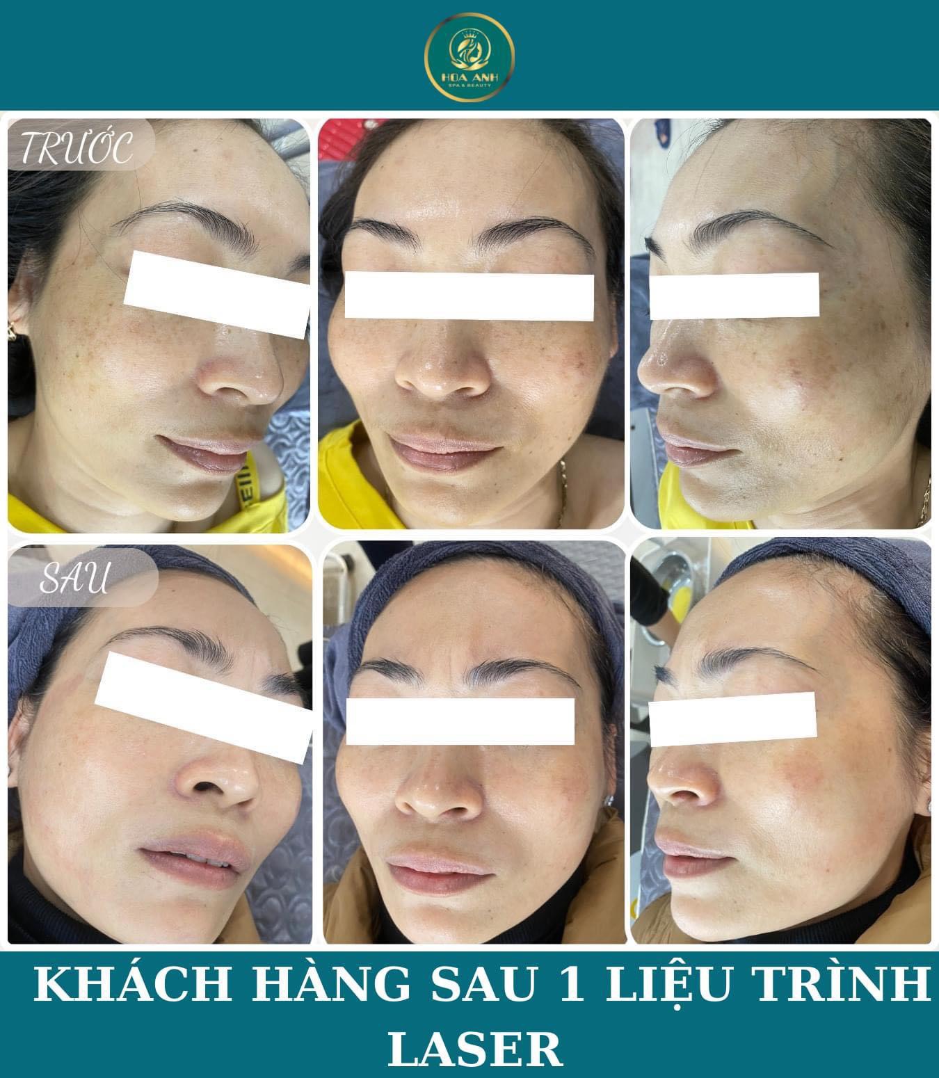 laser xóa tàn nhang