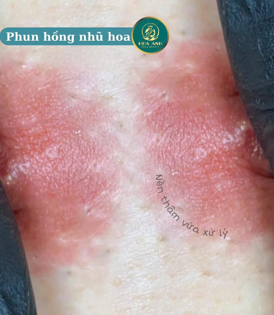 làm hồng nhũ hoa