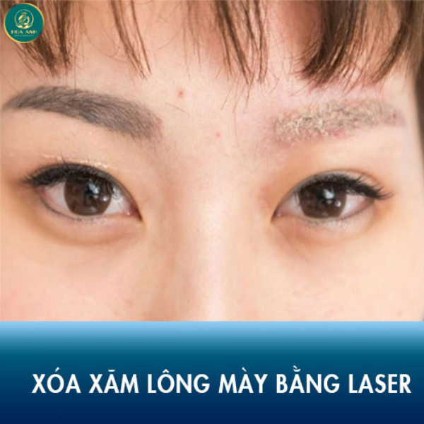laser xóa mày