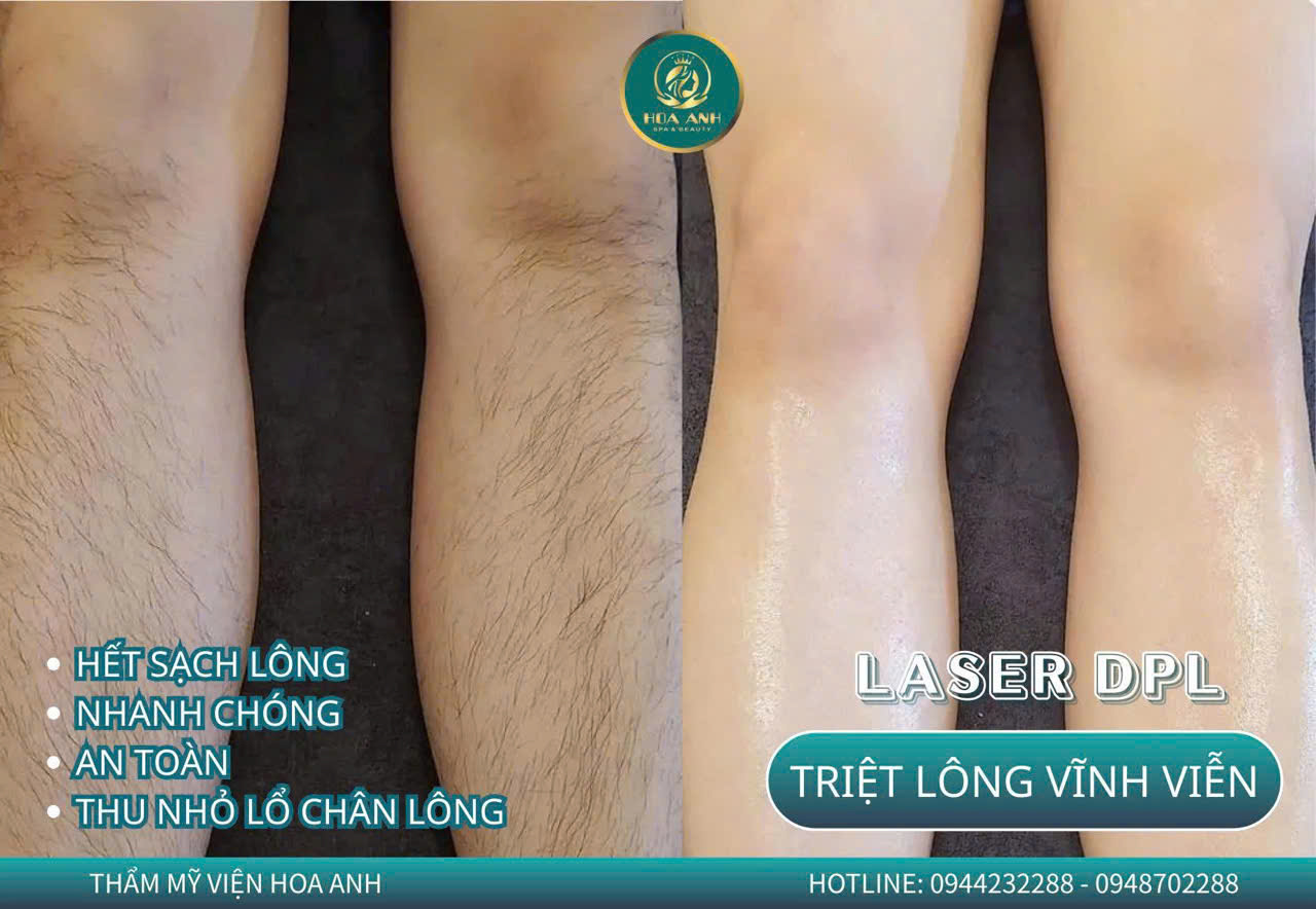 triệt lông vĩnh viễn