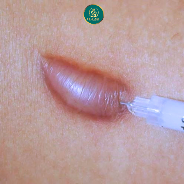 tiêm sẹo lồi
