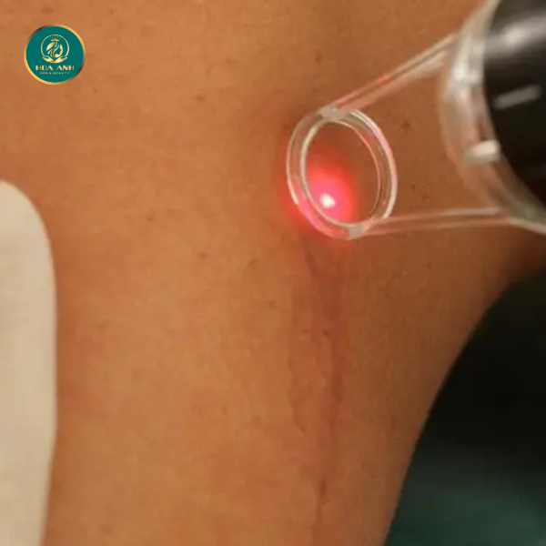 laser trị sẹo lồi