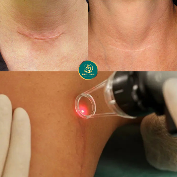 laser điều trị sẹo
