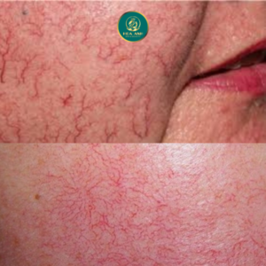 Da nhiễm corticoid nổi mao mạch