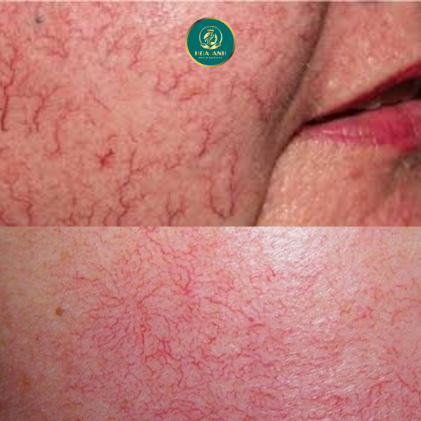 Da nhiễm corticoid nổi mao mạch
