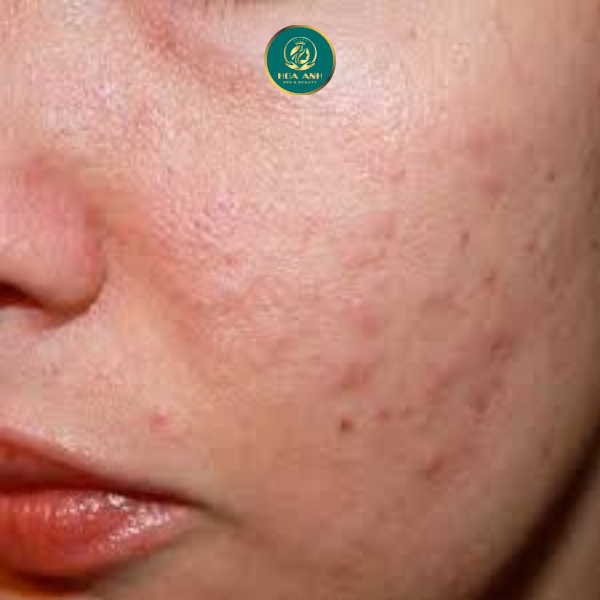 da nổi mụn da nhiễm corticoid