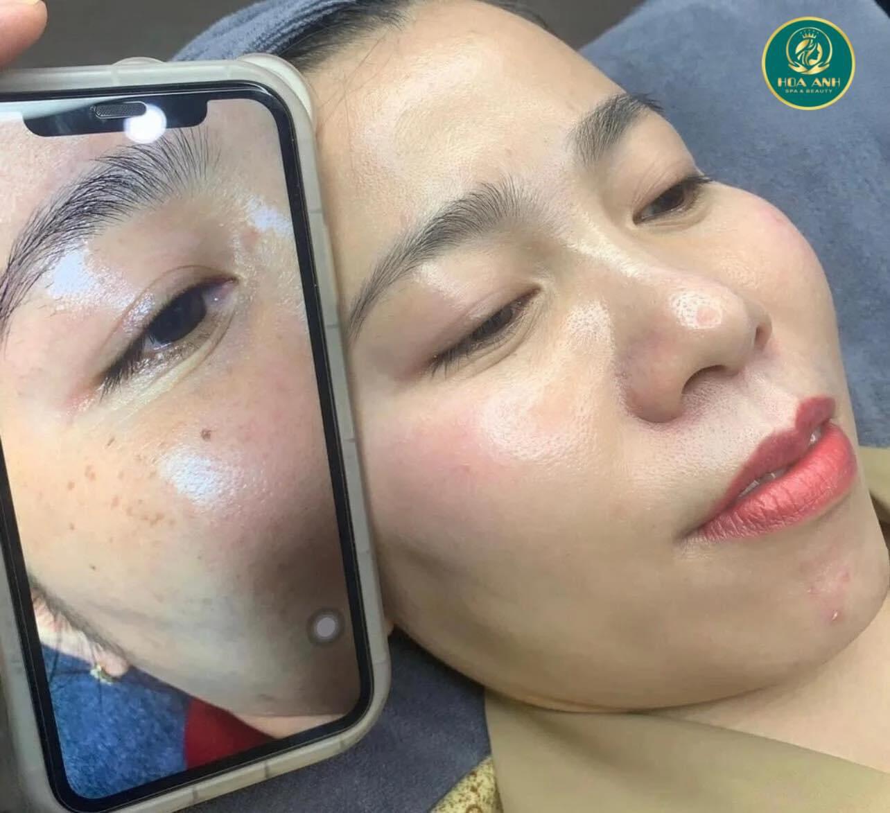 điều trị tàn nhang