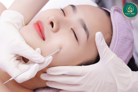 Điều trị mụn