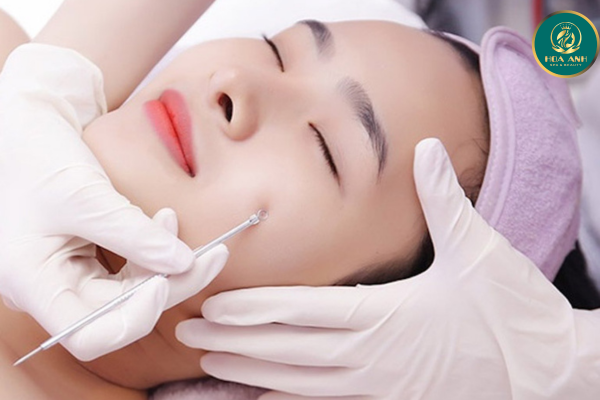 Điều trị mụn