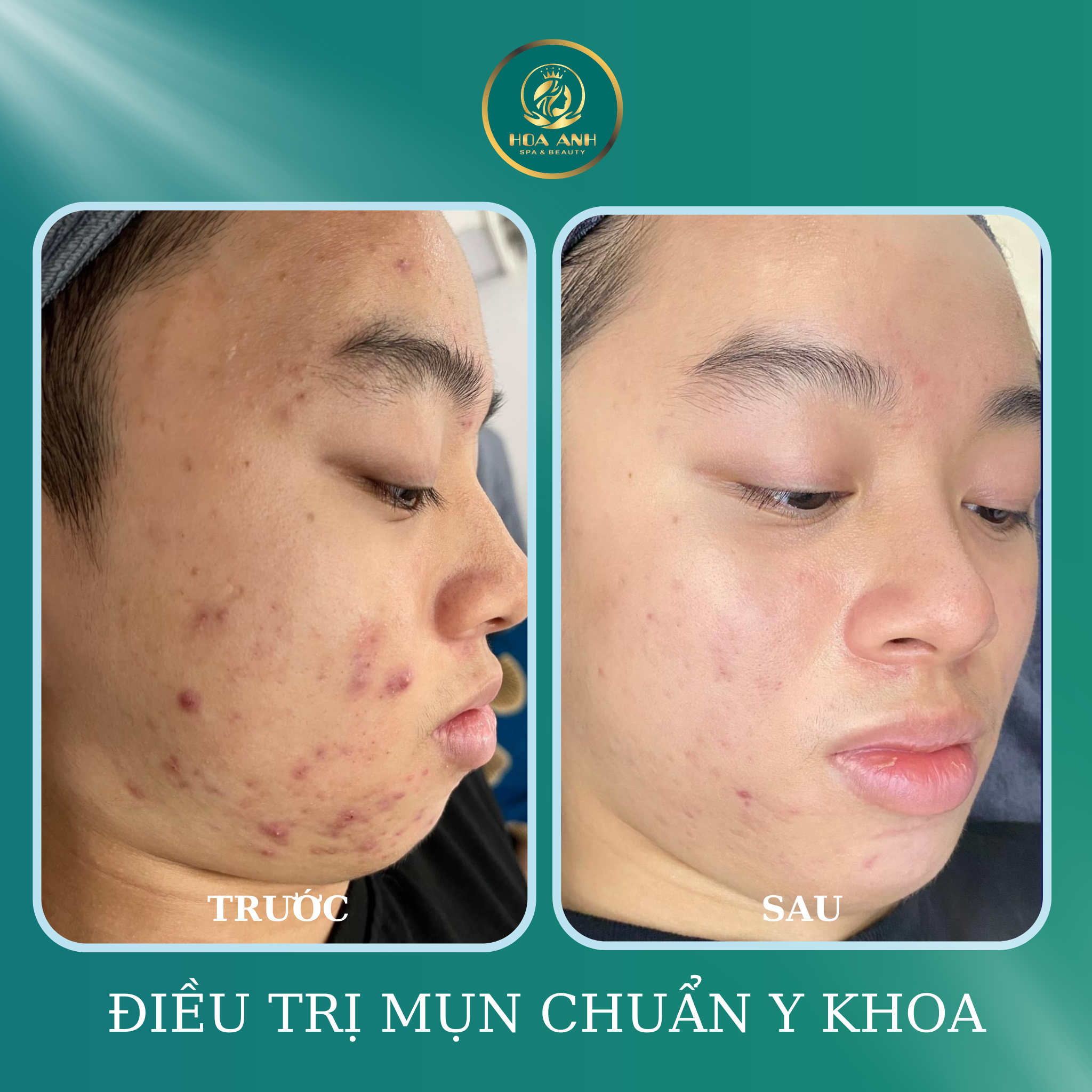 Điều trị mụn