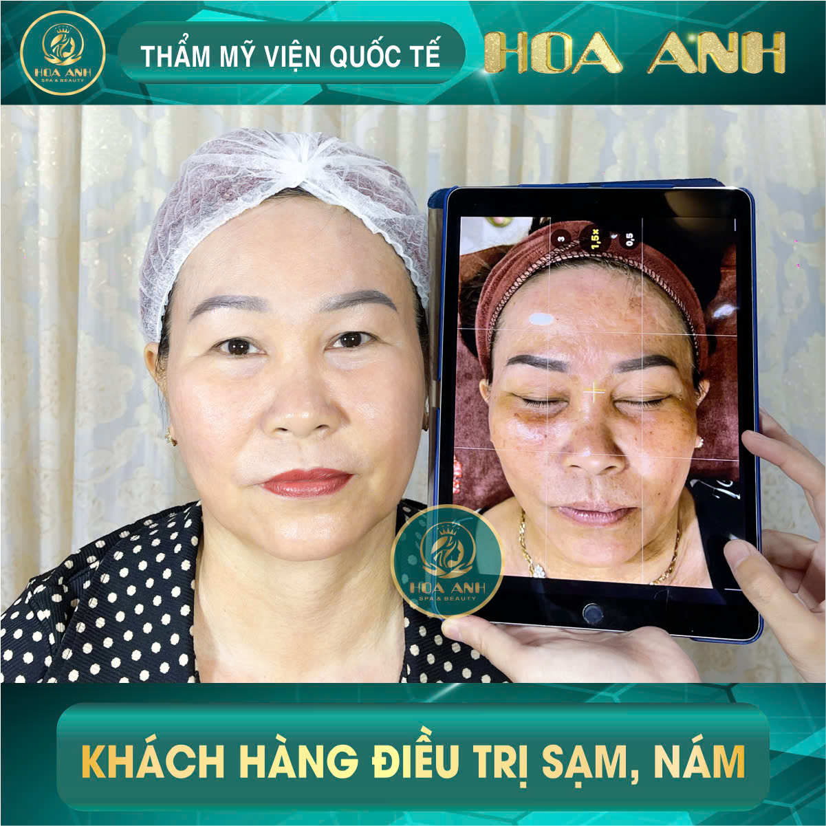 Điều trị nám