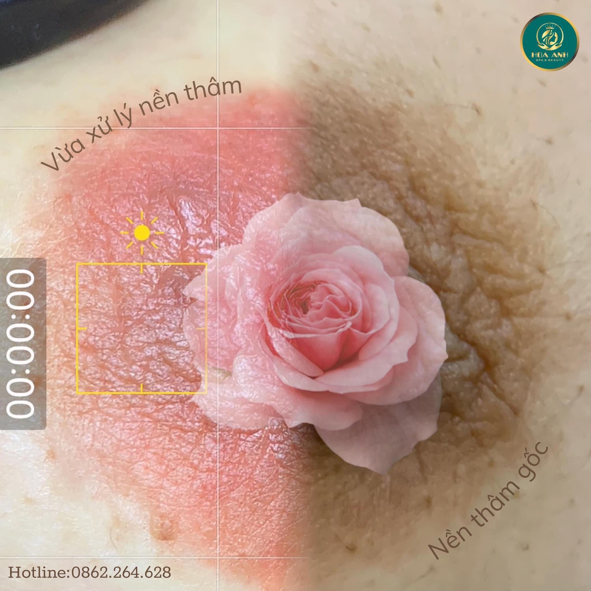 làm hồng nhũ hoa